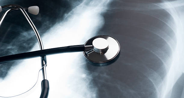 Causes of Bronchiectasis