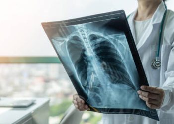 Doctor examining chest X-ray to assess lung inflammation and bronchitis cause