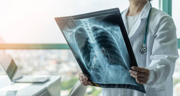 Doctor examining chest X-ray to assess lung inflammation and bronchitis cause