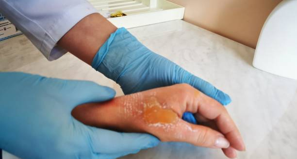 Doctor examining a large blister on a patient's hand wearing blue gloves
