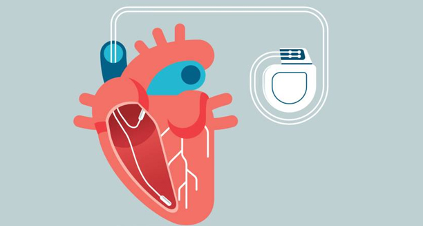 Medical illustration of heart with pacemaker showing electrical pathway