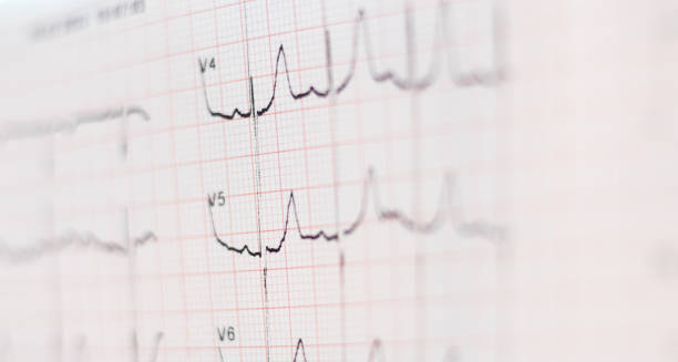 Close-up of ECG readings showing abnormal heart activity