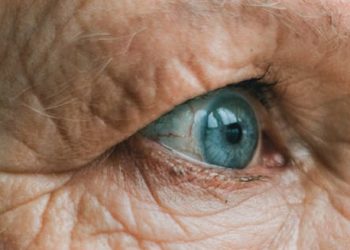 Close-up of an elderly person's eye with visible signs of cataract