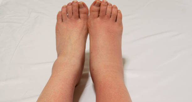 Swollen and inflamed right foot compared to a normal left foot
