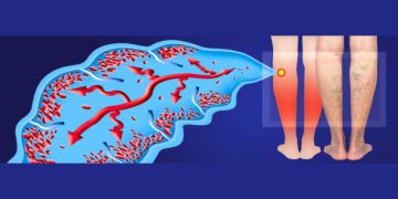 Diagram showing nerve and muscle involvement in a leg affected by Charcot-Marie-Tooth Disease