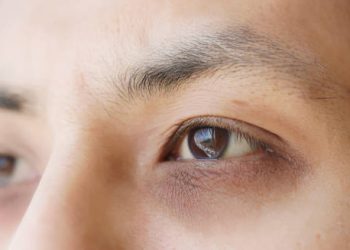 Causes of Charles Bonnet Syndrome