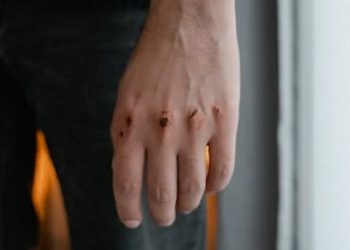 Injured hand showing bruised and cut knuckles, a common cause of a broken finger