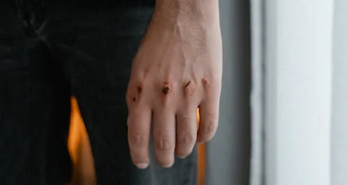 Injured hand showing bruised and cut knuckles, a common cause of a broken finger