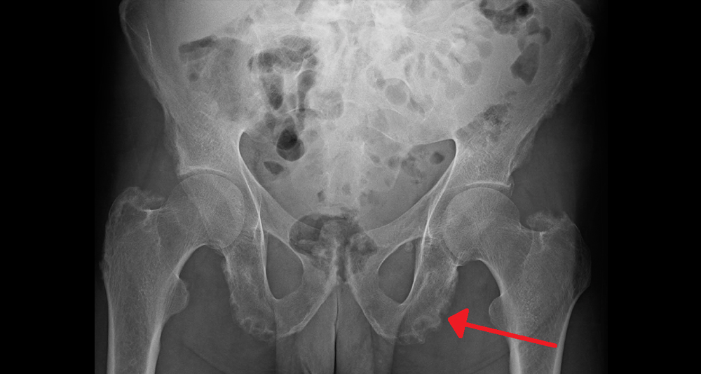 X-ray of pelvis with red arrow indicating fracture area