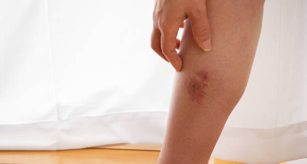 Person touching an inflamed red patch on the lower leg