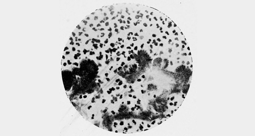 Complications and Long Term Outlook of Actinomycosis