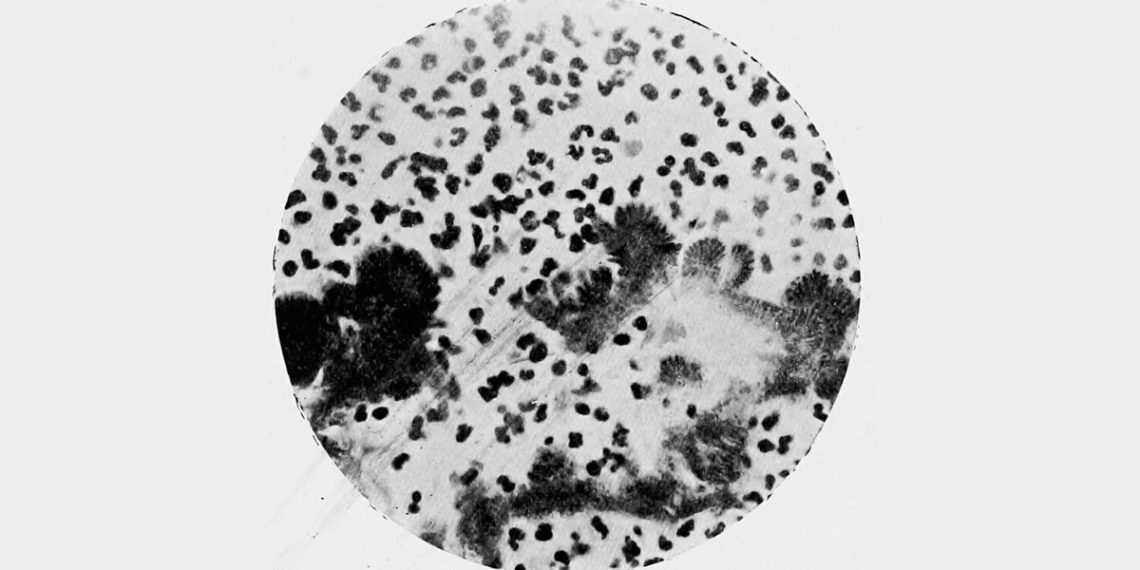 Complications and Long Term Outlook of Actinomycosis
