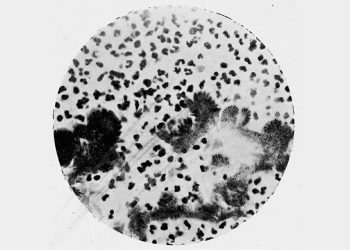Complications and Long Term Outlook of Actinomycosis