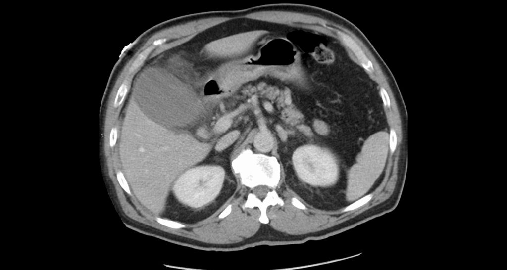 Complications and Long-Term Outlook of Acute Cholecystitis