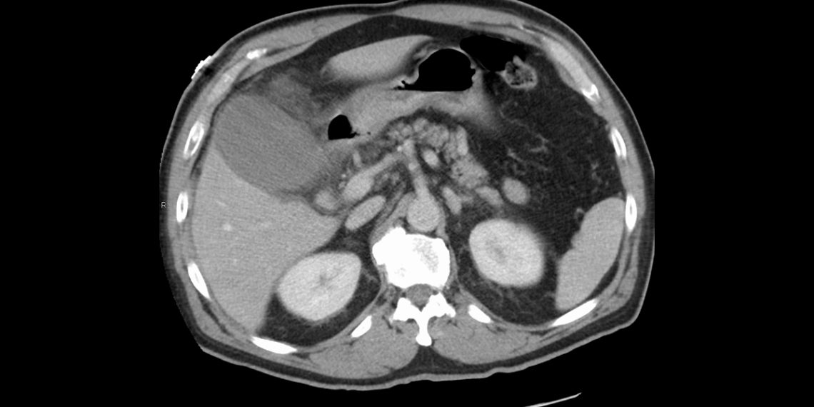 Complications and Long-Term Outlook of Acute Cholecystitis