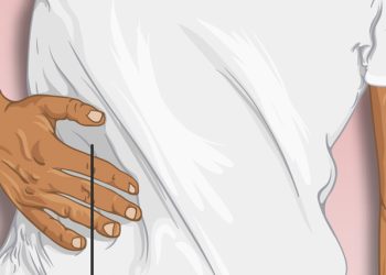 Illustration of a person clutching the right side of their abdomen, indicating pain linked to bile duct cancer complications.