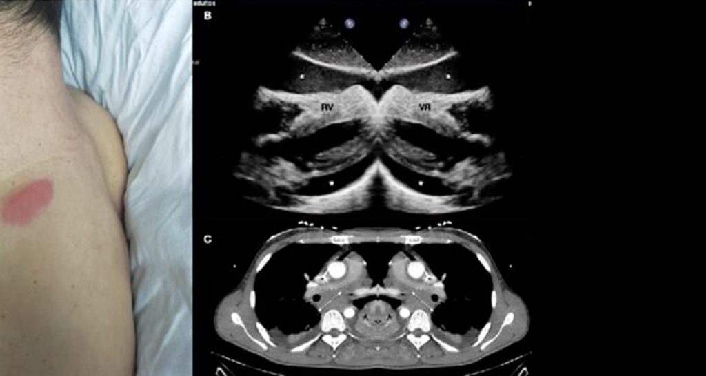 Complications and Recovery Outlook of Acute Lymphoblastic Leukaemia