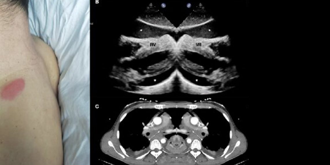 Complications and Recovery Outlook of Acute Lymphoblastic Leukaemia
