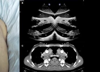 Complications and Recovery Outlook of Acute Lymphoblastic Leukaemia