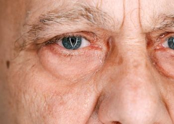 Close-up of elderly man's eyes after cataract surgery