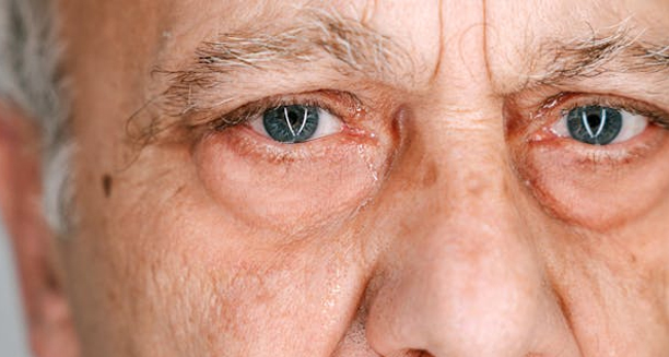 Close-up of elderly man's eyes after cataract surgery