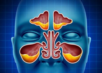 Medical illustration of sinus inflammation and nasal passages showing complications of cavernous sinus thrombosis