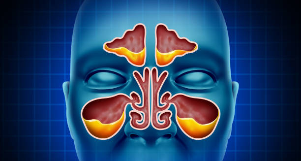 Medical illustration of sinus inflammation and nasal passages showing complications of cavernous sinus thrombosis