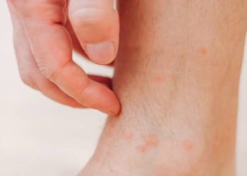 Complications and Recovery from Cellulitis