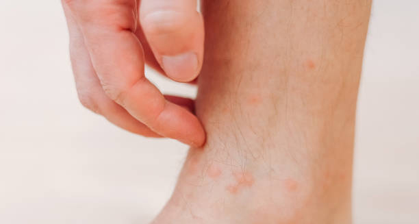 Complications and Recovery from Cellulitis