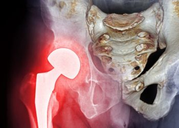 X-ray of a hip replacement highlighting complications from a fractured hip