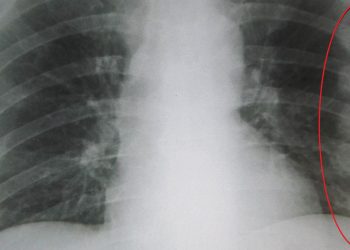 Chest X-ray showing bruised rib area with red circle highlighting injury