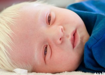 Complications of Albinism