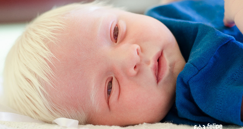 Complications of Albinism