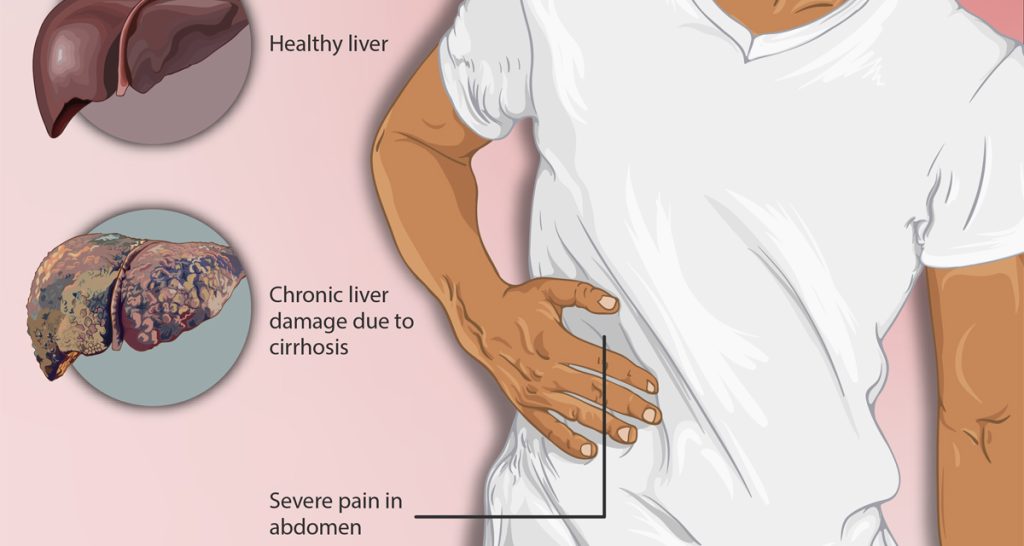 Complications of Alcohol-Related Liver Disease