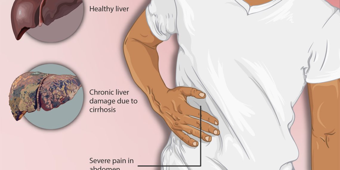 Complications of Alcohol-Related Liver Disease