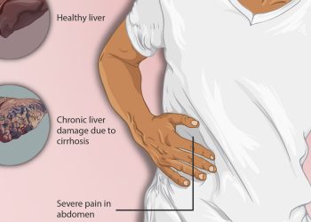 Complications of Alcohol-Related Liver Disease