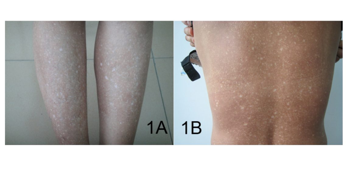 Complications of Amyloidosis