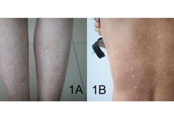 Complications of Amyloidosis