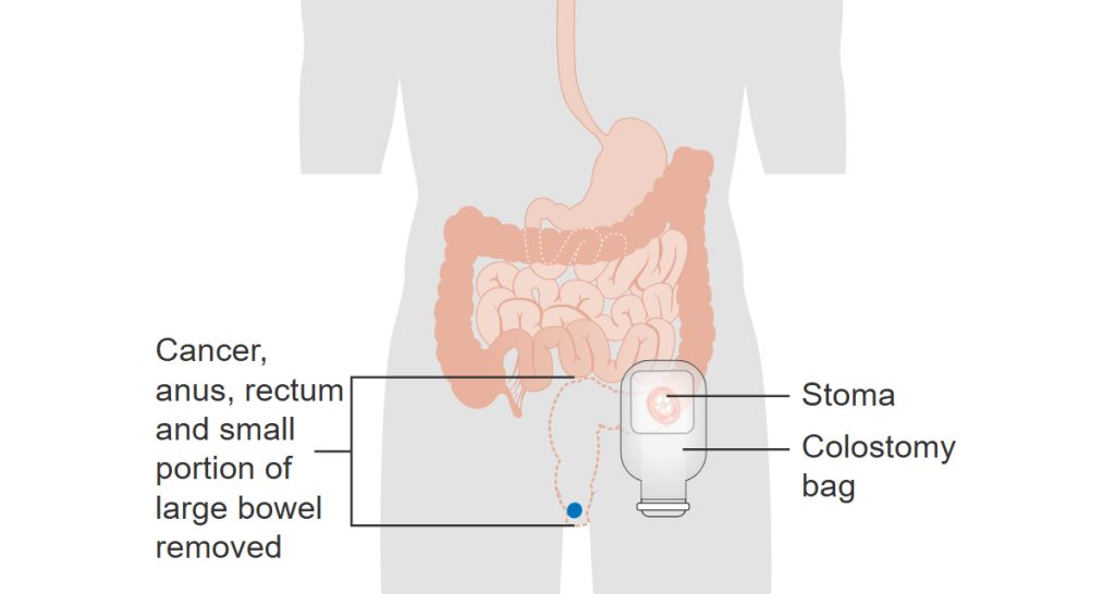 Complications of Anal Cancer
