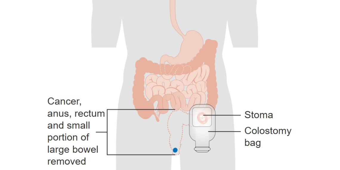Complications of Anal Cancer