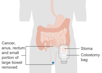 Complications of Anal Cancer