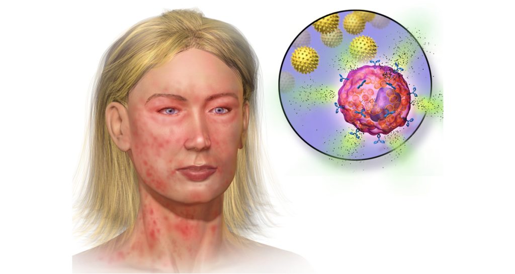 Complications of Anaphylaxis