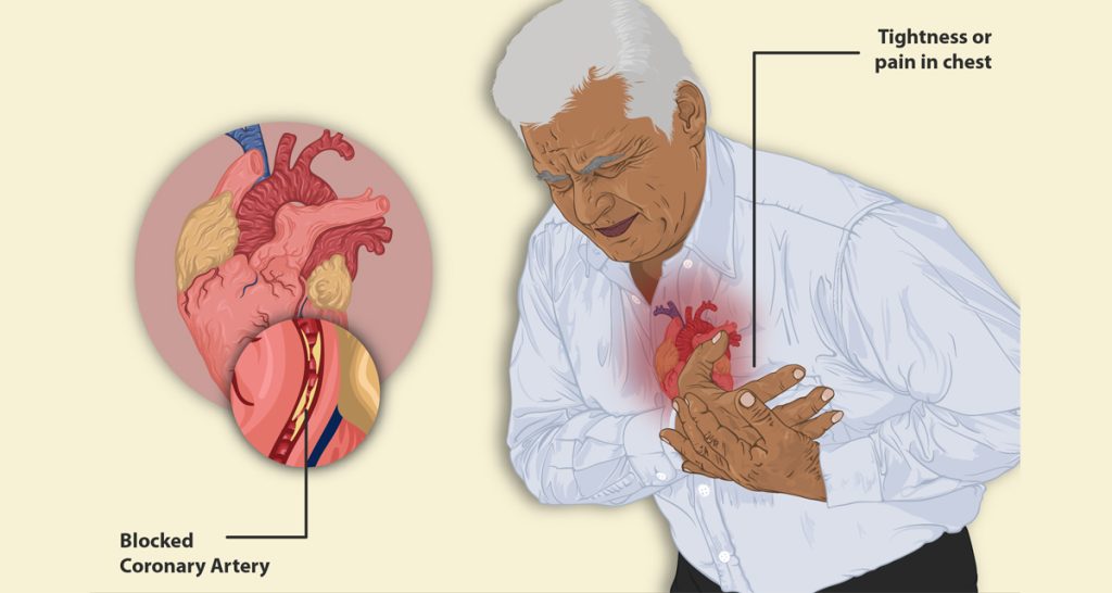 Complications of Angina