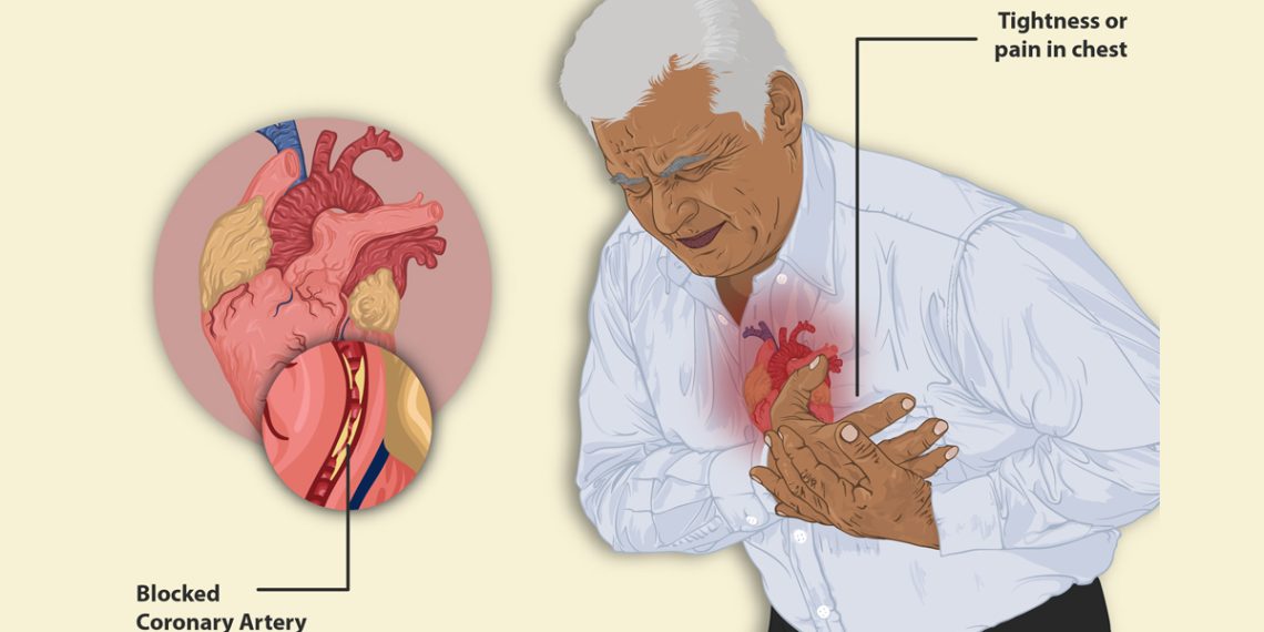 Complications of Angina