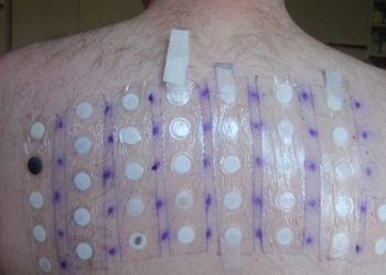 Complications of Angioedema