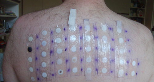 Complications of Angioedema