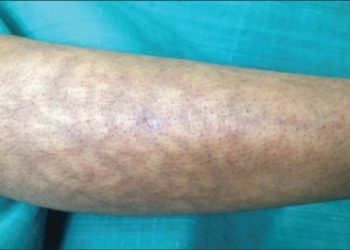 Complications of Antiphospholipid Syndrome