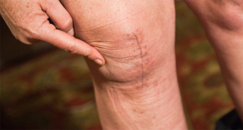 Complications of Arthritis