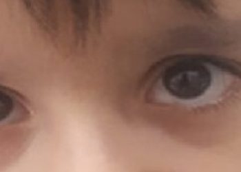 Complications of Ataxia