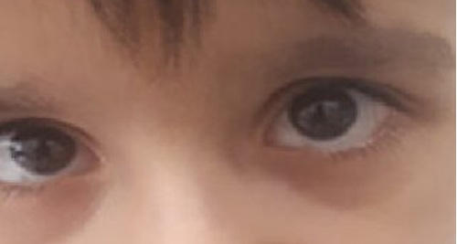 Complications of Ataxia